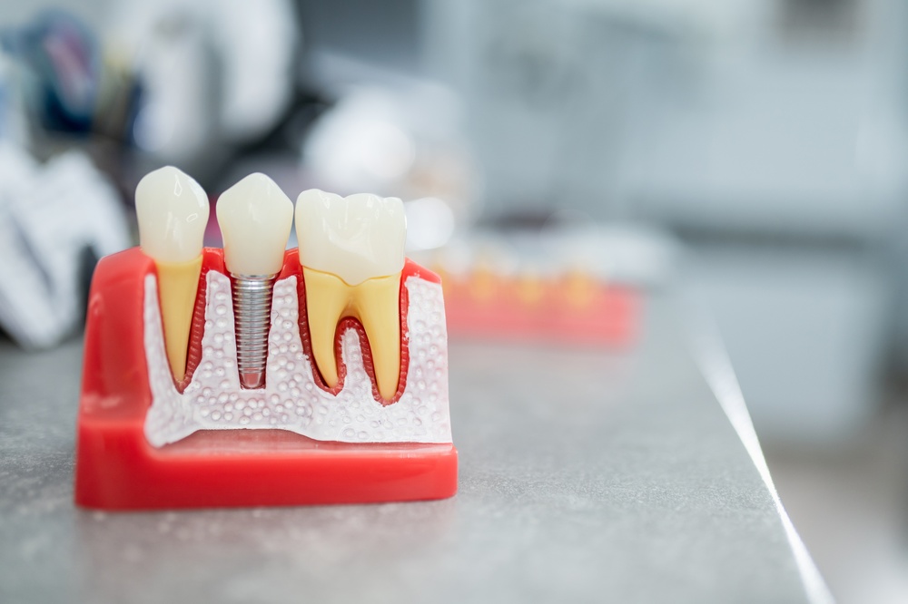 Navigating Tooth Restorations: Crowns, Bridges and Implants Explained